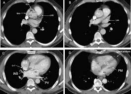 Webmd's heart anatomy page provides a detailed image of the heart and provides information the heart has four chambers: Cardiac Findings On Non Gated Chest Computed Tomography A Clinical And Pictorial Review European Journal Of Radiology