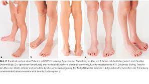 Lexikon der syndrome und fehlbildungen.ursachen, genetik, risiken (7. Orthopadische Aspekte Zur Therapie Des Cmt Fusses Im Wachstumsalter Orthopadie Traumatologie Universimed Medizin Im Fokus