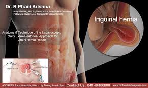 Aatomy Technique Of The Laparoscopic In 2020 Hernia Repair Gastroenterologist Umbilical Hernia