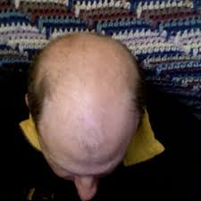 What to do in this case? What To Do About Hair Loss Remedies And Treatments Bellatory