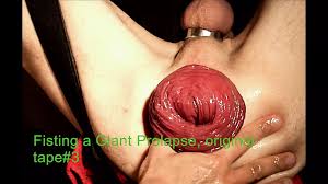 Fisting a Giant Prolapse Original Tape 3: French Gay Interracial Porn