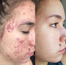 How to do a chemical peel at home. Mesoestetic Chemical Peels The Look By Louise