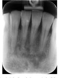 Check spelling or type a new query. Pdf Cbct Findings Of Periapical Cemento Osseous Dysplasia A Case Report Semantic Scholar