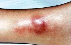 Image result for Panniculitis