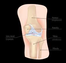 Image result for gout symptoms knee