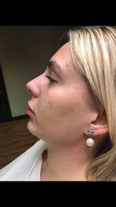 Package 6 ml💉 Cheeks -Chin