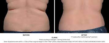 How To Get Rid Of Love Handles | Fat Reduction Coolsculpting