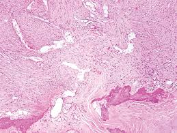 mesothelioma is a type of cancer that develops from the thin layer of tissue that covers many of the internal organs (known as the mesothelium). Challenges And Controversies In The Diagnosis Of Malignant Mesothelioma Part 2 Malignant Mesothelioma Subtypes Pleural Synovial Sarcoma Molecular And Prognostic Aspects Of Mesothelioma Bap1 Aquaporin 1 And Microrna Journal Of Clinical Pathology