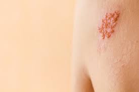 Ans eso si que es 20 dolares ! Que Es El Herpes Zoster Culebrilla Contagio Y Tratamiento Cinfasalud