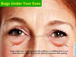 What Causes Bags Under Your Eyes And How To Get Rid Of It Bagsunderyoureyes Eyes Eyecaretips Medications Eye Bags Puffy Bags Under Eyes Puffy Eyes Remedy