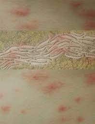 Voorkom huiduitslag, jeuk en andere klachten om tijdig de nesten uit de eikenbomen te laten verwijderen. Jeuk En Pijn Door De Eikenprocessierups Huidinfo Nl Dermatoloog