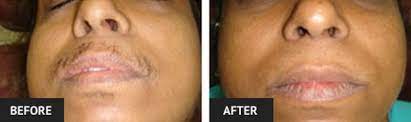 Watch my first ipl video: Laser Hair Removal Before And After Pictures Laser Lipo Vein Center