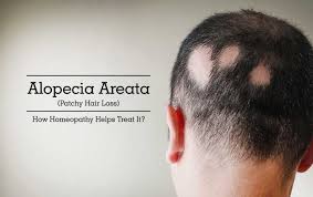 Hair loss due to syphilis. Homeopathic Medicine For Alopecia Areata Homeopathic Treatment