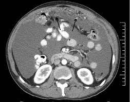 This name is very confusing since there is no relation with the malignant mesothelioma. Malignant Mesothelioma Axial Ct Image Shows Diffuse Cystic Peritoneal Download Scientific Diagram