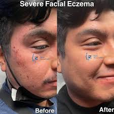 Image result for ekzema face