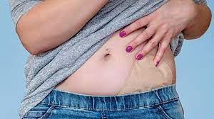 Facts About Living With An Ostomy Everyday Health