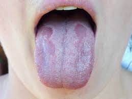 Image result for oral thrush symptoms roof of the mouth