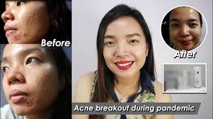 How I treat my acne during a pandemic using Luxe Organix products (May  improvement ba?)