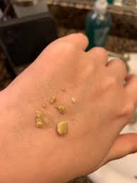 When it comes to clear food stuck in throat, the heimlich maneuver is one of the most effective. Couldn T Sleep Because Something Felt Stuck In My Throat Then I Coughed These Up Popping