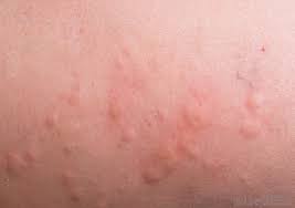 A blackberry bush is super easy to grow at home, too, hardy from zones three through nine. What Are The Signs Of A Raspberry Allergy With Pictures