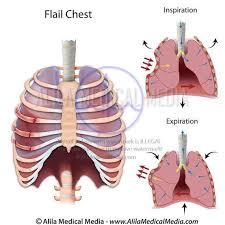 Image result for Flail Chest