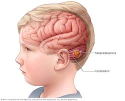Your child's doctor may have a specialist called a pediatric neurologist check your child. Medulloblastoma Overview Mayo Clinic