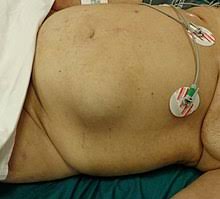 Bleeding from cancerous tumors in the colon can make stool look very dark or even black. Spigelian Hernia Wikipedia