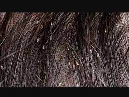 Their presence can cause itchy skin irritation, which seems to worsen at night. Head Lice In Black People S Hair