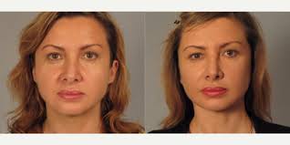 Henry Mentz, MD, FACS, Board Certified Plastic Surgeon