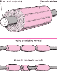 Levantar por sí misma, y la trasladan a una clínica donde le hacen el terrible diagnóstico: Sindrome Guillain Barr Pagina 2 Monografias Com