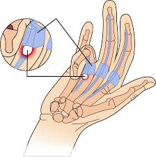 Image result for Trigger Finger