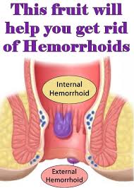 This Fruit Will Help You Get Rid Of Hemorrhoids Getting Rid Of Hemorrhoids Home Remedies For Hemorrhoids Hemorrhoid Relief
