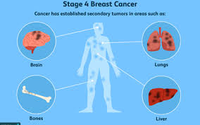 Drug therapies that control metastatic breast cancer throughout the body can also help treat the pain caused by bone metastases. Complications Of Advanced Metastatic Breast Cancer