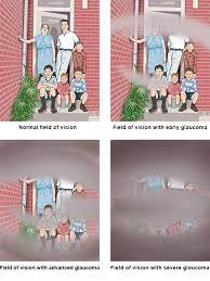 Glaucoma is a group of eye diseases that can cause vision loss and blindness by damaging a nerve in the back over time, you may slowly lose vision, usually starting with your side (peripheral) vision. Glaucoma Informedhealth Org