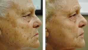 The technology of sciton broadband light (bbl) sets the new standard for hair removal. Foreveryoung Bbl Treatments Laser Hair Removal Laser Tattoo Removal Dermacare Hr