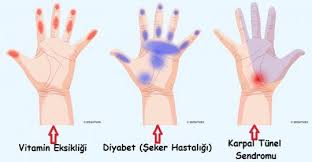 Ellerde Karincalanma Uyusma Halsizlik Saglik Hayata Dair Ipuclari Saglik Ipuclari