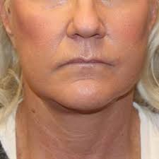 Call 800.801.3101 to book your consultation appointment. Oshkosh Appleton Facelift Photos Fox Valley Plastic Surgery