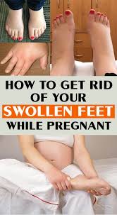 Pin On Swollen Feet Remedies