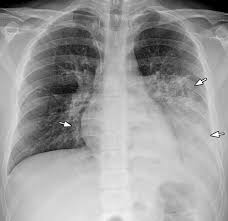 Preconditioning rat with three lipid emulsions prior to acute lung injury affects cytokine production and cell apoptosis in the lung and liver. Radiographic And Ct Features Of Viral Pneumonia Radiographics