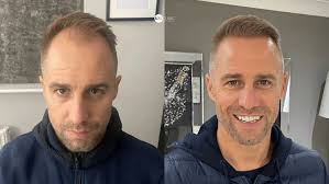 Hair Transplant industry growth