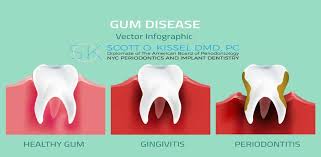 Image result for gingivitis