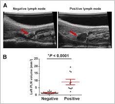 However, according to susan love's book on breast cancer about 2/3 of people with lymph node involvement go on to get seondary breast cancer, and 1/3 of people without lymph node involvement do as well. Ultrasound Examination Of Plns In Foot Surface Model Of Melanoma Lymph Download Scientific Diagram