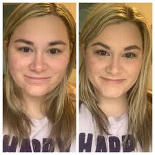 Best clinic for hormonal acne treatment?