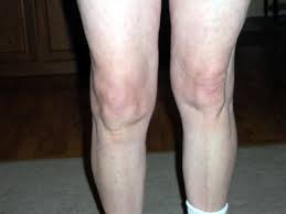 Pin By Eric Kwok On Work Out In 2020 Knee Replacement Knee Replacement Surgery Knee Replacement Surgery Recovery