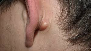 I Ve Had A Lump Behind My Left Earlobe For A Few Months Now It Feels Slightly Sore To The Touch Is This Cancerous Quora