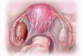 Ask your doctor about a laparoscopy. Understanding The Effect Of Surgery On Ovarian Reserve In Women With Endometriomas And Endometriosis Consult Qd