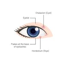 Image result for milium cyst on eyelid