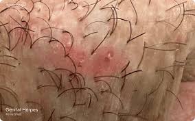 Image result for genital herpes
