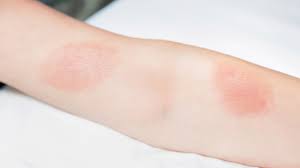 Gifteiche ist ein gemeinsames werk in den bewaldeten gebieten nordamerikas gefunden. Poison Oak Rash Pictures And Remedies