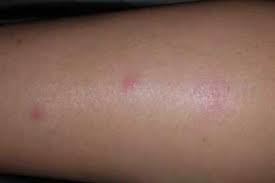 Image result for bedbugs bites